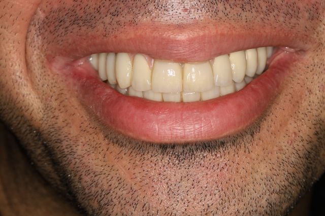 Treatment example: All-on-6