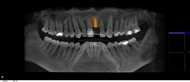 3-D X-Ray, Felix Wick