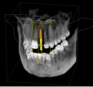 Dental implant 300x280
