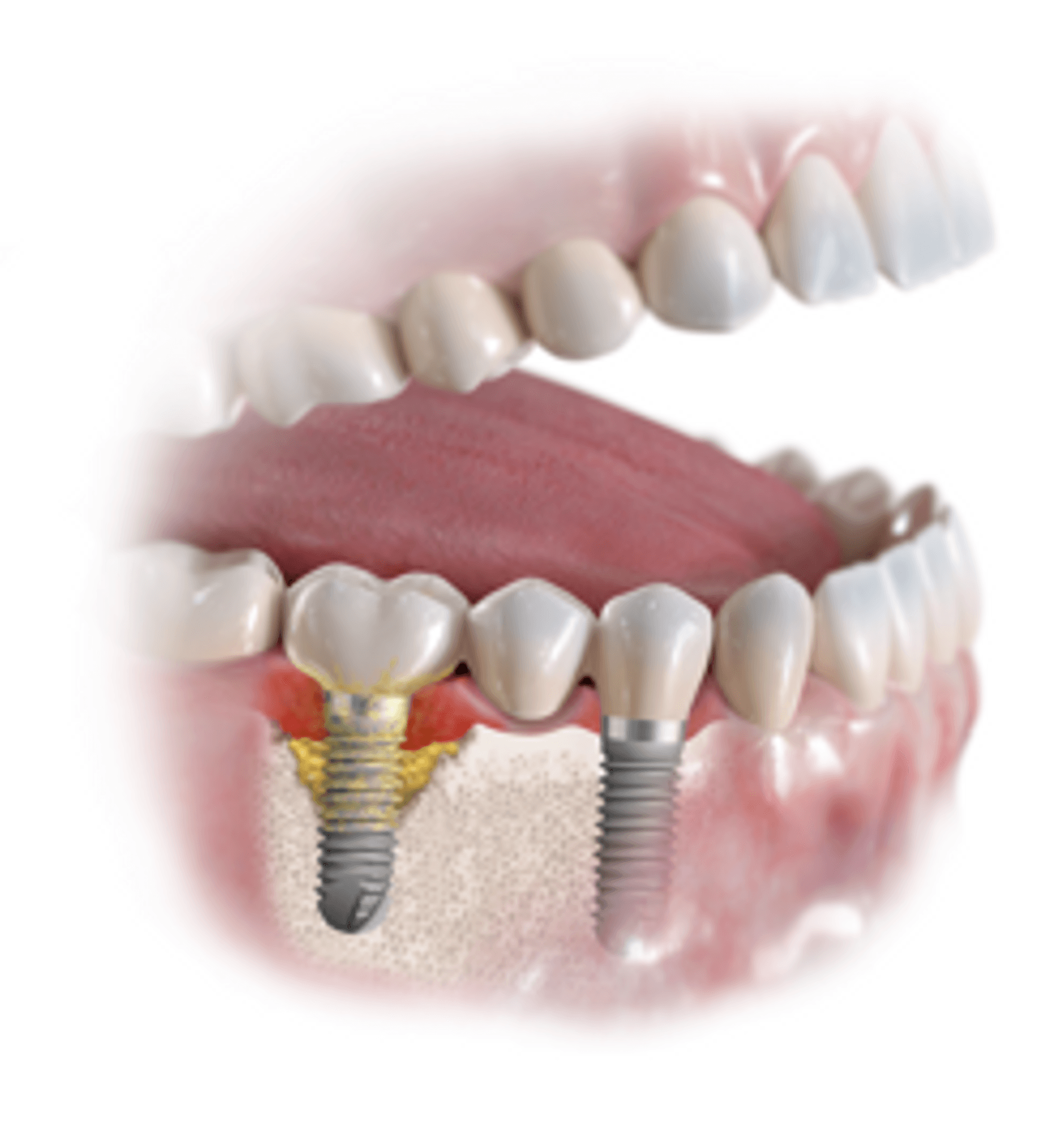 Fortgeschrittene Entzündung um ein Zahnimplantat