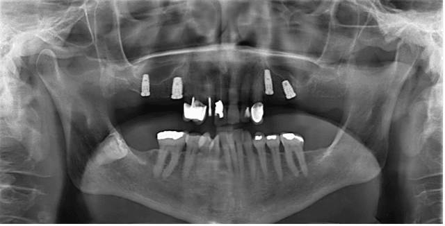 Step 3: Final X-ray with implants