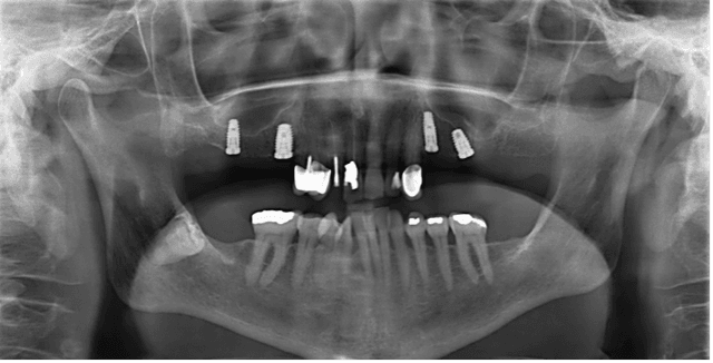 Schritt 3: Abschlussröntgen mit Implantaten