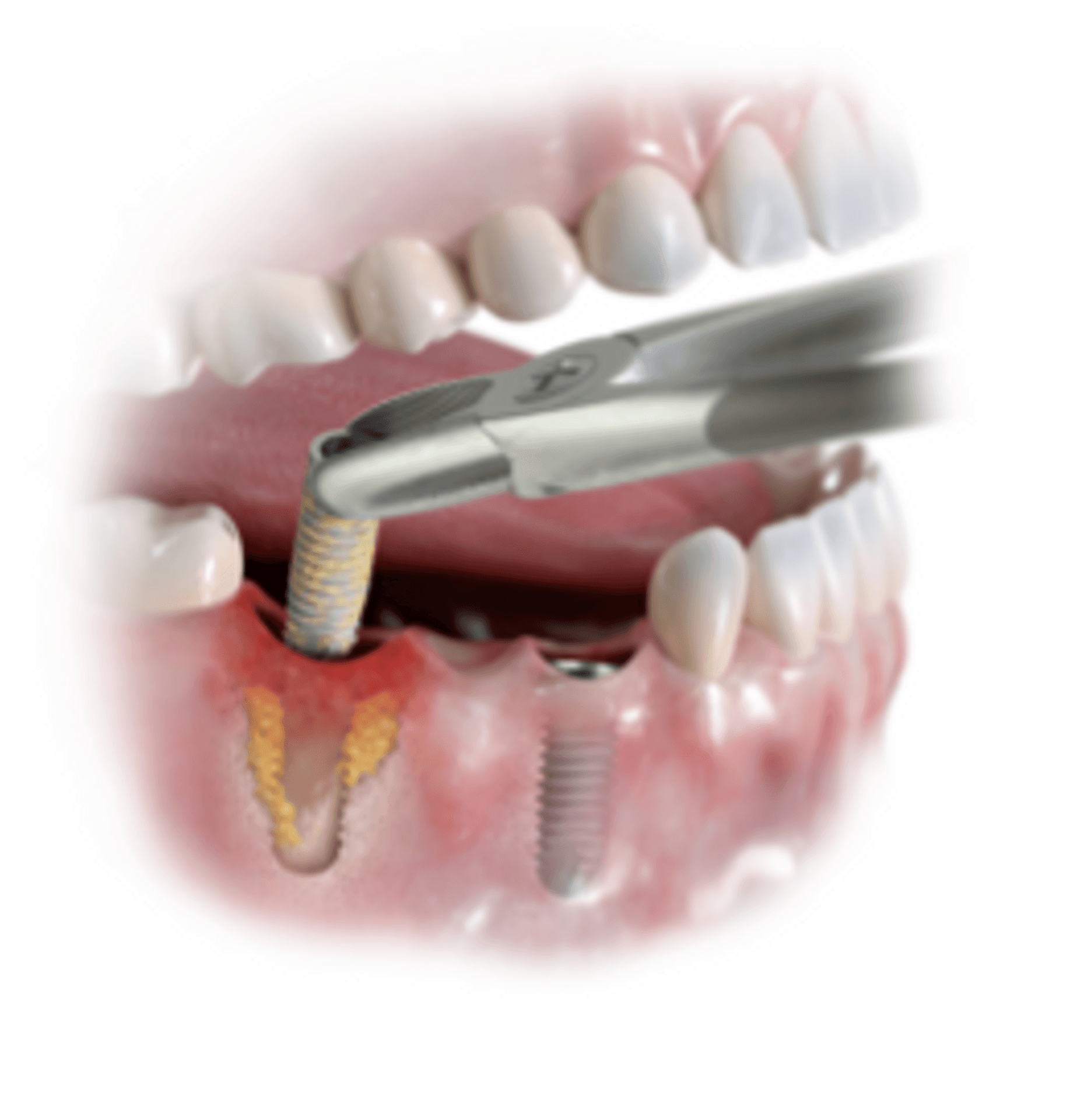 Entfernen des Implantats