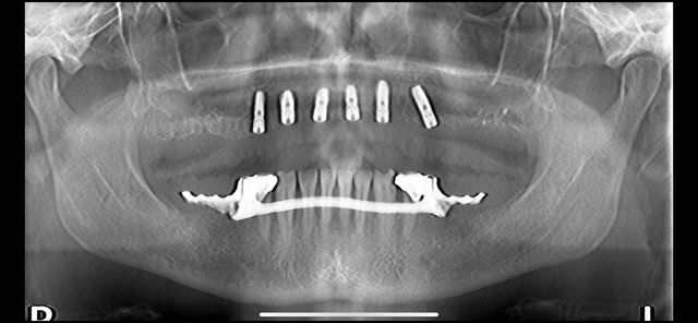 X-Ray Image of multiple tooth replacements