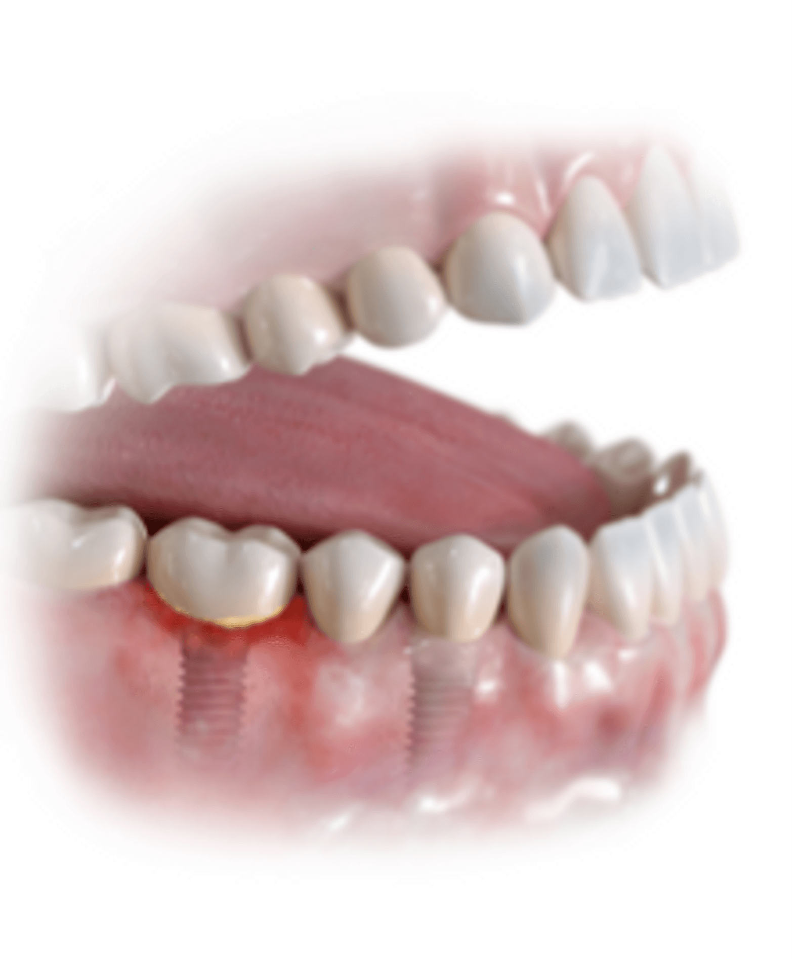  Leichte Entzündung um ein Zahnimplantat 