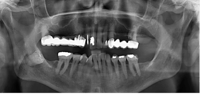 Step 1: Initial X-ray