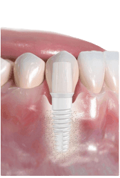Ceramic Implant