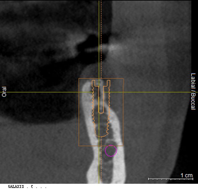 Digitale Fallplanung im Unterkiefer bei etwas eingeschränktem Knochenangebot, geplant ist hier ein einzelnes Zahnimplantat mit gleichzeitigem horizontalem Knochenaufbau.